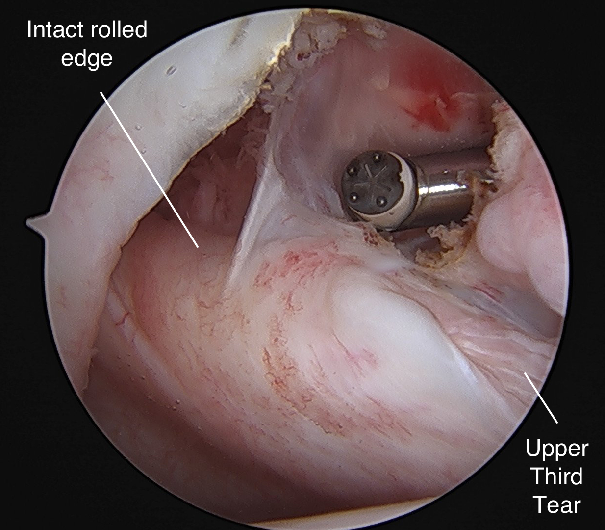 Tears of the Subscapularis: Hidden and Forgotten, No More! - Shoulder